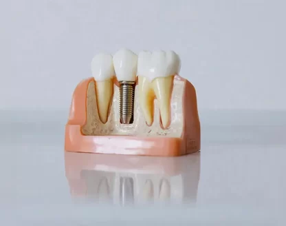 Is Recovery After Dental Implants Painful? Symptoms, Timeline & Tips 