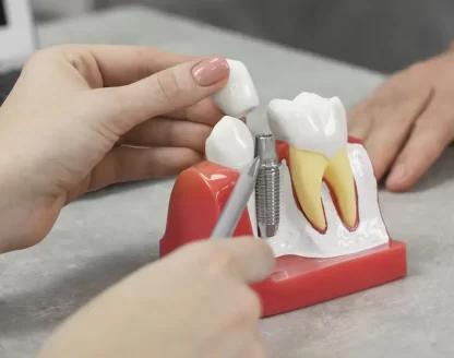How long does swelling last after dental implants? 