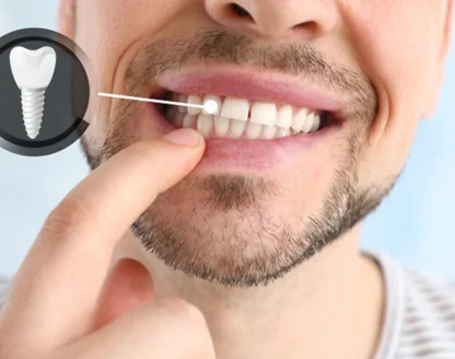 Bleeding Around a Dental Implant? When to See a Dentist 